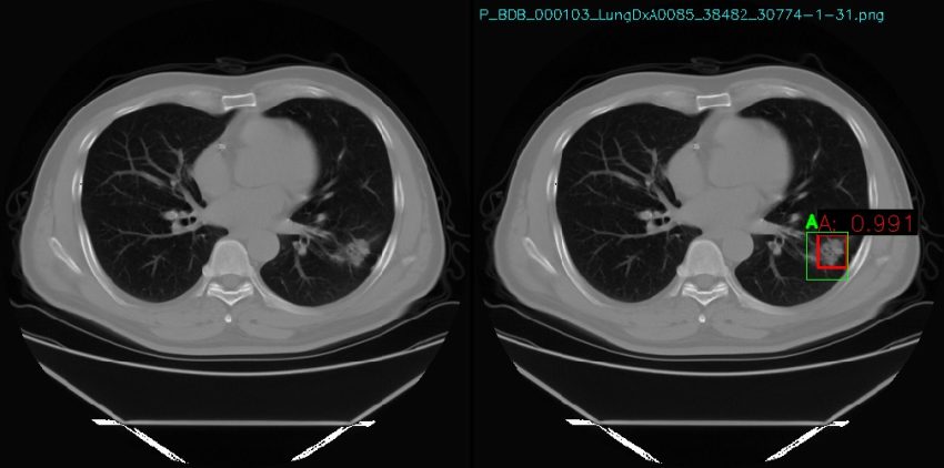 Politécnico de Setúbal e CCG/ZGDV desenvolvem plataforma que usa IA para melhorar o diagnóstico do cancro